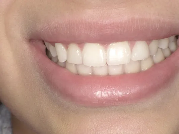After image