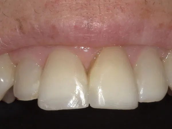 After image