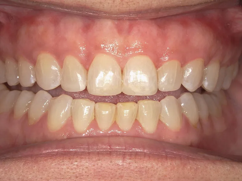 After image