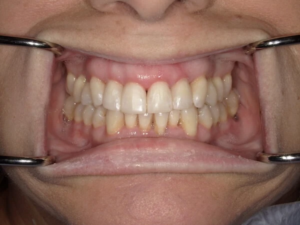 After - BIOCLEAR Black Triangles Restorations at Creative Smiles Dentistry
