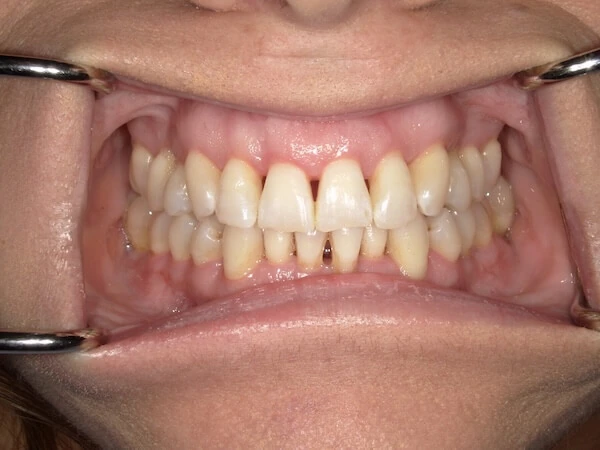 Before - BIOCLEAR Black Triangles Restorations at Creative Smiles Dentistry